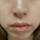 その他（肌） エースクリニック 大阪梅田HEPナビオ院 BEFORE サムネイル用