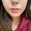 ハイフ（顔） 共立美容外科 大阪本院 BEFORE サムネイル用