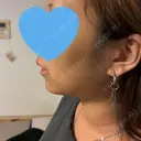 ボトックス（あご） / ヒアルロン酸注入（あご） 大阪TAクリニック BEFORE サムネイル用