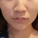 ボトックス（エラ・小顔） / ボトックス（肩） / シワ取りボトックス / ボトックス（額） BITO BEAUTY CLINIC BEFORE サムネイル用