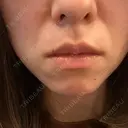 オリジオ Chloe Cheongdam Clinic （クロエチョンダムクリニック） BEFORE サムネイル用