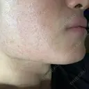 医療脱毛（顔） ZX-CLINIC 梅田院 BEFORE サムネイル用