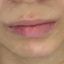 アートメイク（唇） 岸上歯科クリニック BEFORE サムネイル用