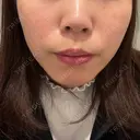 脂肪溶解注射（顔） BAO CLINIC 神戸院 BEFORE サムネイル用