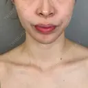 その他（鼻） / 鼻孔縁下降 アリエル美容クリニック 大宮院 BEFORE サムネイル用