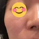 ボトックス（あご） / ボトックス（エラ・小顔） / シワ取りボトックス / ボトックス（眉間） LE CLINIC BEFORE サムネイル用