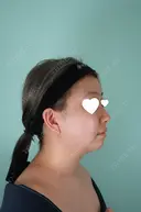 鼻尖形成（切開） / 鼻中隔延長（切開） / 小鼻縮小（切開） / 軟骨移植 / 骨切幅寄せ / 鼻柱下降・鼻唇角形成（猫手術） WOM CLINIC GINZA （ワム クリニック ギンザ） BEFORE サムネイル用