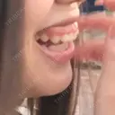 ガミースマイル手術 南青山矯正歯科 BEFORE サムネイル用