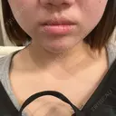 ボトックス（エラ・小顔） BiBiクリニック BEFORE サムネイル用