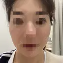 その他（肌） / ルメッカ ルラ美容クリニック 新宿院 BEFORE サムネイル用