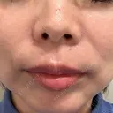 ヒアルロン酸注入（唇） KIMI CLINIC 形成・美容外科 BEFORE サムネイル用