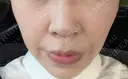 ヒアルロン酸注入（頬） ルラ美容クリニック 岡山院 BEFORE サムネイル用