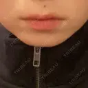 ヒアルロン酸注入（あご） R Beauty CLINIC 名古屋院 BEFORE サムネイル用