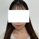 バッカルファット除去 / メーラーファット除去 / ボトックス（あご） / ヒアルロン酸注入（あご） First Clinic BEFORE サムネイル用