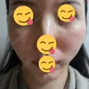 骨切り（あご） / 骨削り（エラ） / 骨削り（頬） / 輪郭修正 ナム整形外科 BEFORE サムネイル用