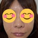 ピーリング（ハリ・ツヤ） Sea Sail Beauty Clinic BEFORE サムネイル用