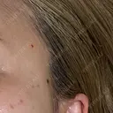 ほくろ・いぼ除去レーザー（肌） Fellez Clinic【フェルズクリニック】 BEFORE サムネイル用