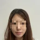 バッカルファット除去 / 脂肪吸引（顔） First Clinic BEFORE サムネイル用