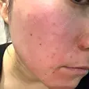 ダーマペン BELINDA CLINIC（ベリンダクリニック）新宿院 BEFORE サムネイル用
