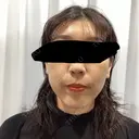 ピーリング（ニキビ・毛穴） / ルメッカ 大美会クリニック 梅田院 BEFORE サムネイル用