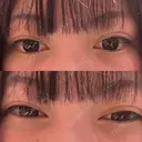 ヒアルロン酸注入（涙袋） / ヒアルロン酸注入（唇） HAAB BEAUTY CLINIC 南青山本院（新院） BEFORE サムネイル用