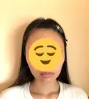 糸リフト / 脂肪吸引（顔） EMMA CLINIC（エマクリニック） BEFORE サムネイル用