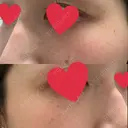 ルメッカ ルラ美容クリニック 郡山院 BEFORE サムネイル用