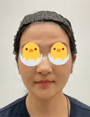 糸リフト / バッカルファット除去 / 脂肪吸引（顔） / 額を丸く / 脂肪吸引（脚） / 脂肪注入（額） / メーラーファット除去 / 脂肪注入（輪郭） First Clinic BEFORE サムネイル用