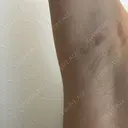 医療脱毛（ワキ） ルラ美容クリニック 新宿院 BEFORE サムネイル用