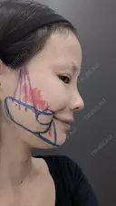 糸リフト / 脂肪吸引（顔） / その他（輪郭） / ジョールファット除去 WOM CLINIC GINZA （ワム クリニック ギンザ） BEFORE サムネイル用