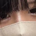 目頭切開 池袋麗歯科・美容皮膚科 BEFORE サムネイル用