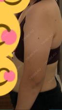 脂肪吸引（二の腕） 湘南美容クリニック 岡山院 BEFORE サムネイル用