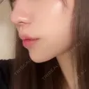 ボトックス（あご） / ヒアルロン酸注入（あご） HAAB BEAUTY CLINIC 名古屋院 BEFORE サムネイル用
