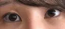 ヒアルロン酸注入（涙袋） サラ美容外科 BEFORE サムネイル用