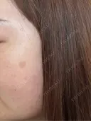 その他（肌） / シミ取りレーザー / ルメッカ ルラ美容クリニック 郡山院 BEFORE サムネイル用