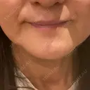 RF（高周波）たるみ治療 / デンシティ 聖心美容クリニック 広島院 BEFORE サムネイル用