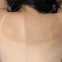 ピコフラクショナルレーザー（毛穴・ニキビ跡） ルラ美容クリニック 広島院 BEFORE サムネイル用