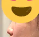 鼻尖形成（切開） / 軟骨移植 id（アイディ）美容外科 BEFORE サムネイル用