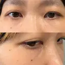 クマ治療 池袋麗歯科・美容皮膚科 BEFORE サムネイル用