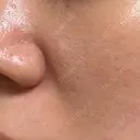 ヴェルヴェットスキン 形成外科と美容外科のクリニック池袋 BEFORE サムネイル用