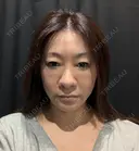 糸リフト / 脂肪吸引（顔） Wing clinic 豊中駅前院 BEFORE サムネイル用