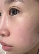 光治療（フォトフェイシャルなど） 眠れるスキンクリニック田町 BEFORE サムネイル用