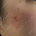 ルメッカ ルラ美容クリニック 郡山院 BEFORE サムネイル用