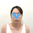 糸リフト / 脂肪吸引（顔） / ジョールファット除去 / 脂肪吸引注射（顔） SEA CLINIC（シークリニック） BEFORE サムネイル用