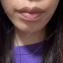 ボトックス（あご） プライベートスキンクリニック 梅田本院 BEFORE サムネイル用