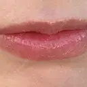 ヒアルロン酸注入（唇） Moon Beauty Clinic BEFORE サムネイル用