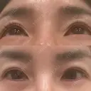 目尻切開 / タレ目形成・グラマラスライン（切開） eクリニック 大阪院 BEFORE サムネイル用