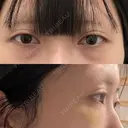 二重埋没 / 小鼻縮小（切開） / 鼻孔縁挙上 / 鼻孔縁下降 アリエル美容クリニック 郡山院 BEFORE サムネイル用
