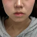 ボトックス（エラ・小顔） BiBiクリニック BEFORE サムネイル用