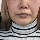 ボトックス（エラ・小顔） / ボトックス（肩） / ボトックス（首） DMTC美容皮膚科 大宮院 BEFORE サムネイル用